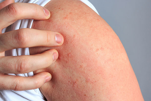 Dermatologie Schermbeck