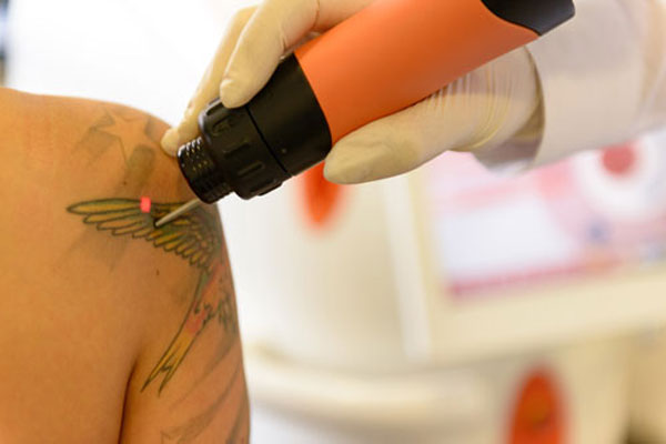 Laser-Tattooentfernung Schermbeck